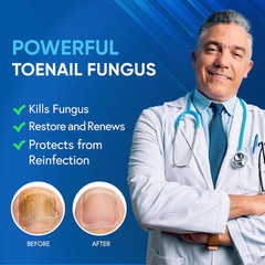 Toenail Fungus Treatment Extra Strength with 25% Undecylenic Acid & Tea Tree Oil